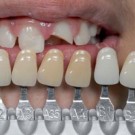 Usklađivanje boje zuba u okviru fiksnoprotetske terapije