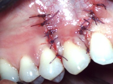 Operacija korena zuba srijeda