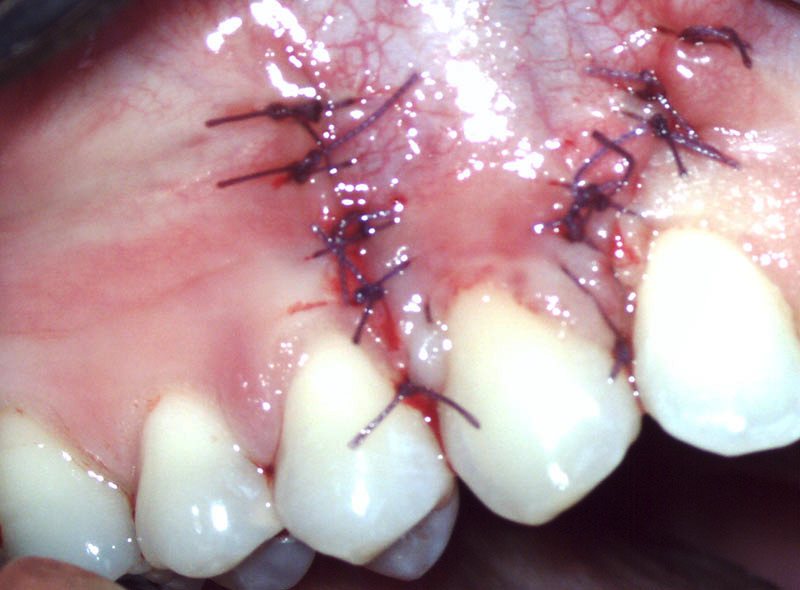 Operacija korijena zuba