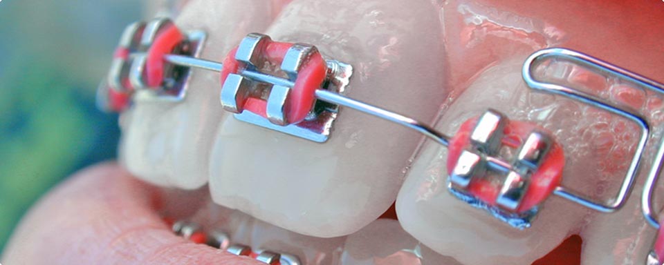 Idealno vrijeme za ispravljanje zuba (ortodonciju) – 2. dio