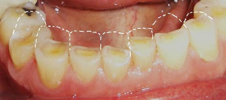 Nekarijesna otteåenja tvdih zubnih tkiva