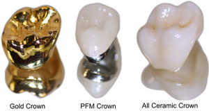 Da li su navlake za zube uvijek dobar izbor?