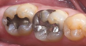 Kada stari ispun treba zamijeniti novim?