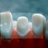 Mehaničko, toplinsko i hemijsko oštećenje zuba prilikom brušenja