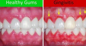 Upala desni – gingivitis