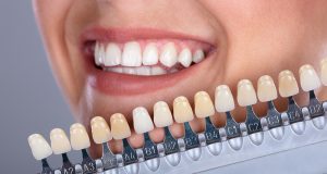 Izbor boje umjetnih zuba