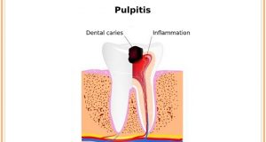 Pulpitis