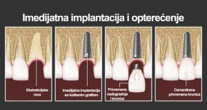 Imedijatno opterećenje implantata