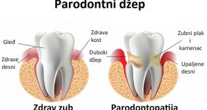 Parodontni džepovi – kako spriječiti njihov nastanak?