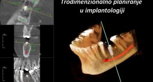 Trodimenzionalno planiranje u implantologiji