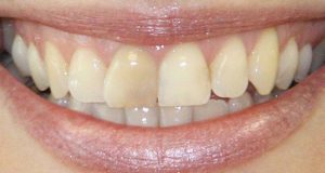 Izbjeljivanje nevitalnih zuba