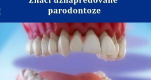 Znaci uznapredovane parodontoze