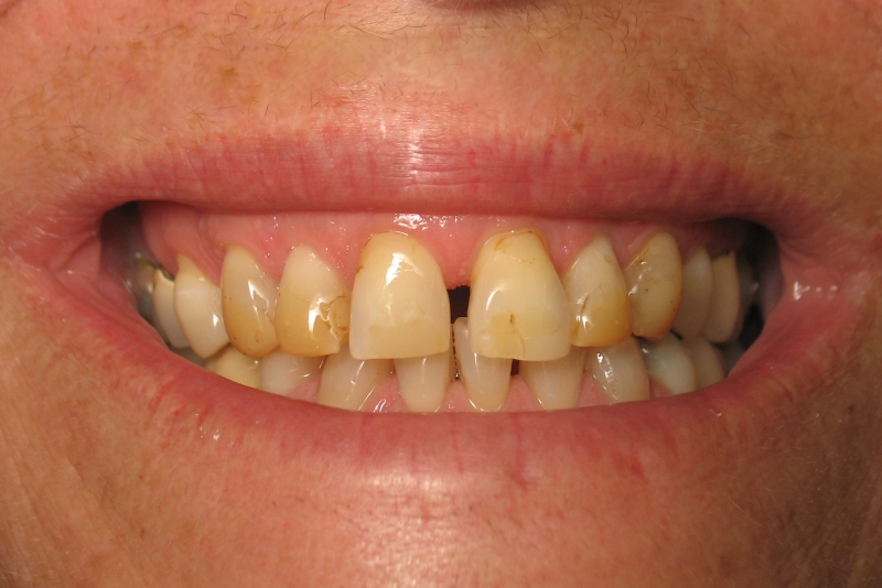 Obojenja ili diskoloracije zuba – I dio