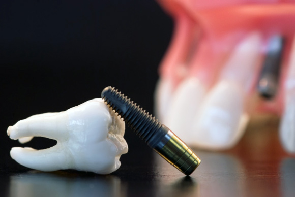 Postavljanje zubnog implanta – II dio (zarastanje, integracija i moguće komplikacije)