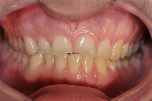 Nekarijesna oštećenja tvdih zubnih tkiva