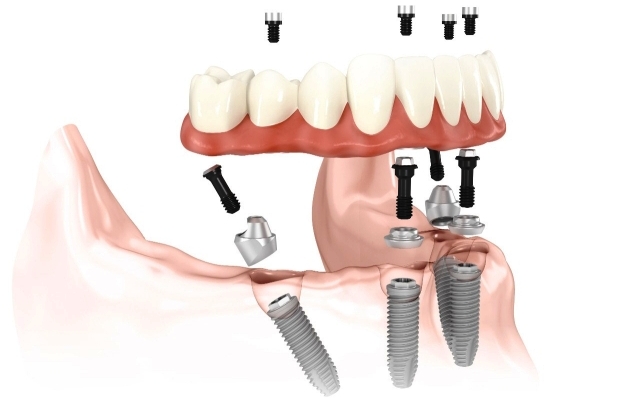 Imedijatno opterećenje zubnog implanta