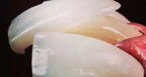 Cementiranje protetskog rada