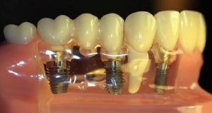 Protetika na implantima