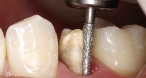 Brušenje vratnog dijela zuba