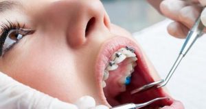 Kada je idealno vrijeme za ortodonciju?