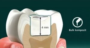 Kompozitni materijal – Bulk