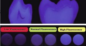 Boja i fluorescencija zuba