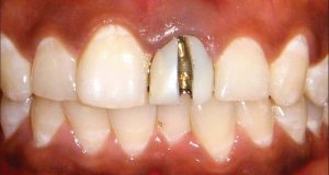 Indikacije za skidanje starog fiksnoprotetskog rada