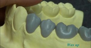 Predprotetska priprema pacijenta