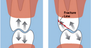 Bol uzrokovana okluzijskom traumom