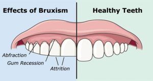 Kako spriječiti škripanje zubima u snu?