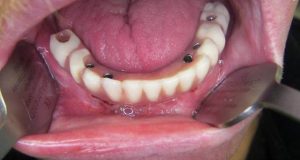 Sredstva za retenciju i stabilizaciju pokrovne proteze na implantatima