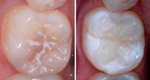 Postupak pečaćenja fisura