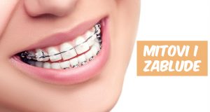 Fiksni aparat za zube – 5 mitova i zabluda