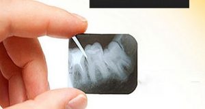 Analogna i digitalna stomatološka rendgenska snimka