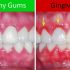 Upala desni – gingivitis