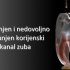 Prepunjen i nedovoljno napunjen korijenski kanal