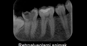 Retroalveolarni snimak zuba