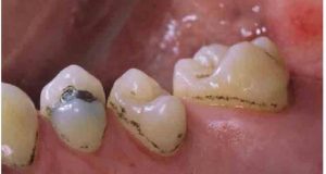 Tamna obojenja na zubima uzrokovana hromogenim bakterijama