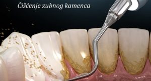 Čišćenje zubnog kamenca