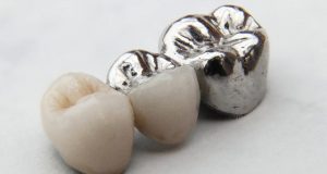 Čvrstoća veze između metala i keramike