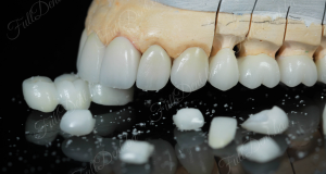 Keramički sistemi u zubotehničkom laboratoriju Full Dent