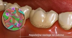 Nepoželjne naslage na zubima