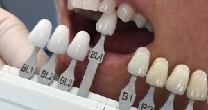 Vizualno određivanje boje zuba